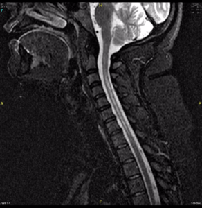 sindrome-de-DEVIC