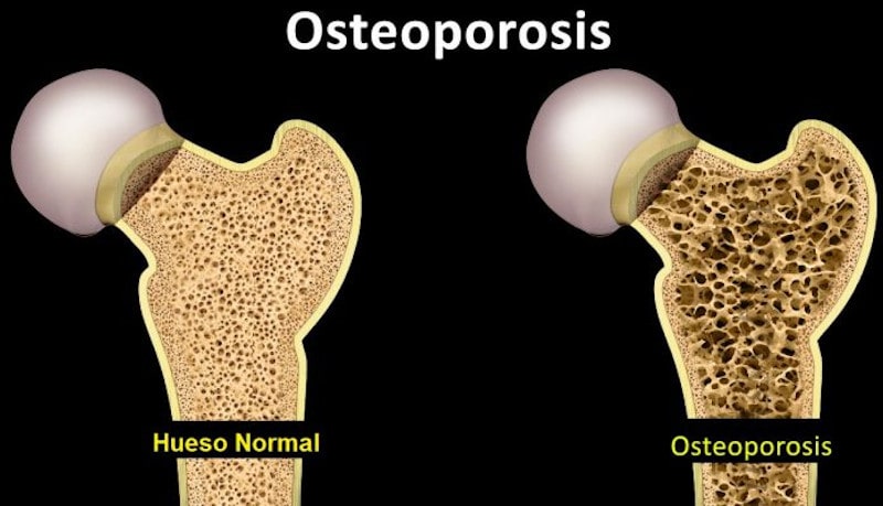 Guía de Osteoporosis