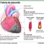 infarto-miocardio