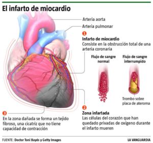 infarto-miocardio