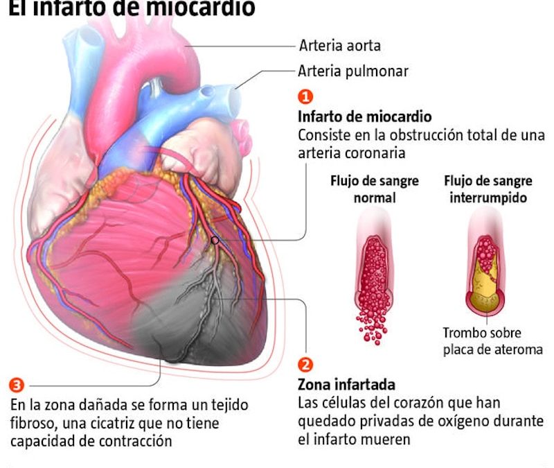 La Matriz Extracelular, implicada en el Infarto de Miocardio