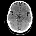neurocisticercosis-epilepsia