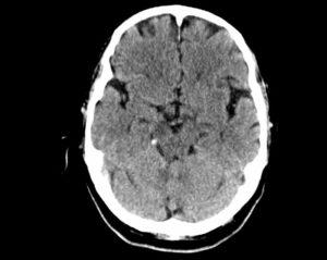 neurocisticercosis-epilepsia