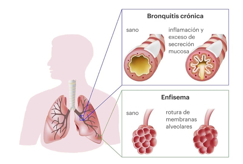 Día Mundial de la Enfermedad Pulmonar Obstructiva Crónica (EPOC)