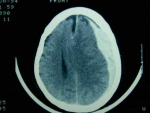 hematoma subdural