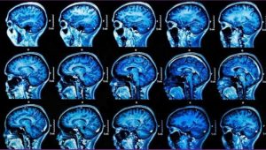 covid-19-neurología