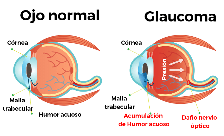 El glaucoma, primera causa de ceguera irreversible en el mundo: ¿podrá curarse algún día?