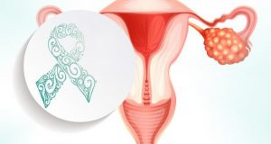 Cáncer-de-Ovario