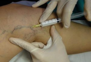 escleroterapia-con-espuma