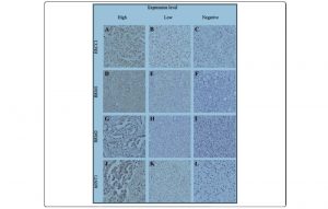 Análisis inmunohistoquímico para la expresión de ERCC1, RRM1, RRM2 y hENT-1