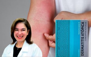 Dermatitis atópica. Conceptos actuales