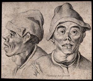 Hombre con bocio. Grabado por J.R. Schellenberg, 1778