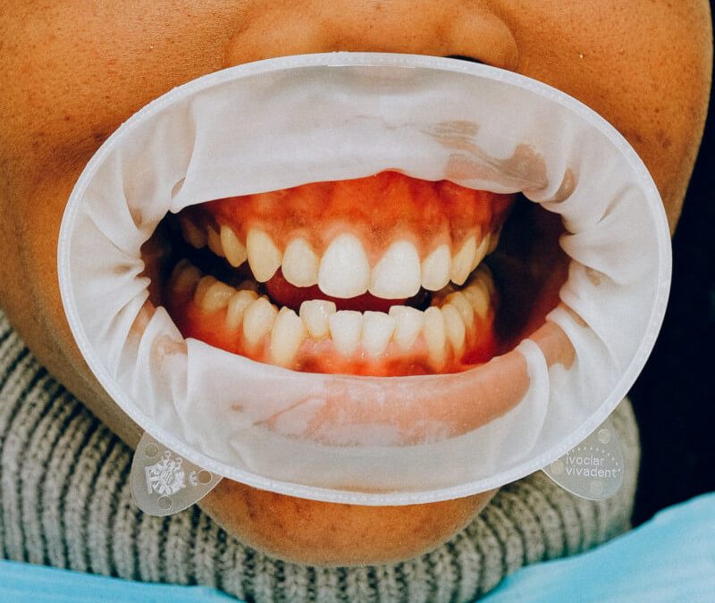 periodontitis-dientes-encías