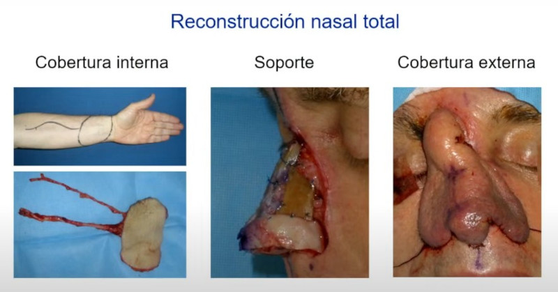 reconstrucción nasal total