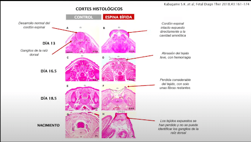 Corrección intrauterina de mielomeningocele por fetoscopia: primera cohorte en Colombia