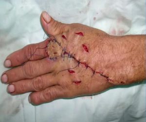 reconstrucción-lesiones-en-piel