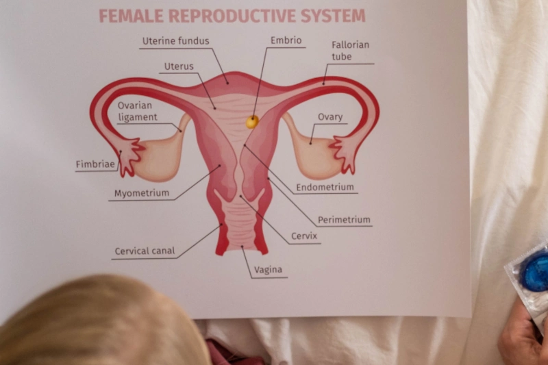 utero-endometriosis