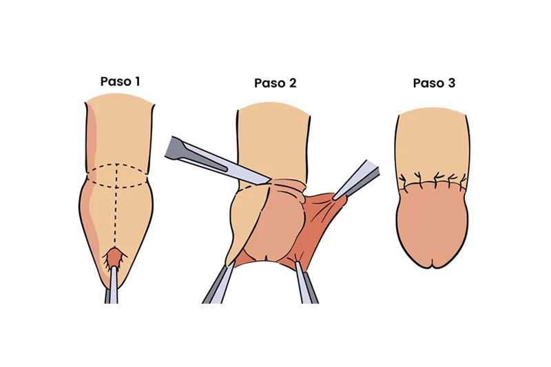 Circuncisión reduce infección por VPH.