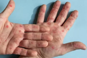 VIRUELA-DEL-MONO-SIMICA