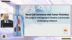 carcinoma_celulas_renales_en_vena_cava_inferior