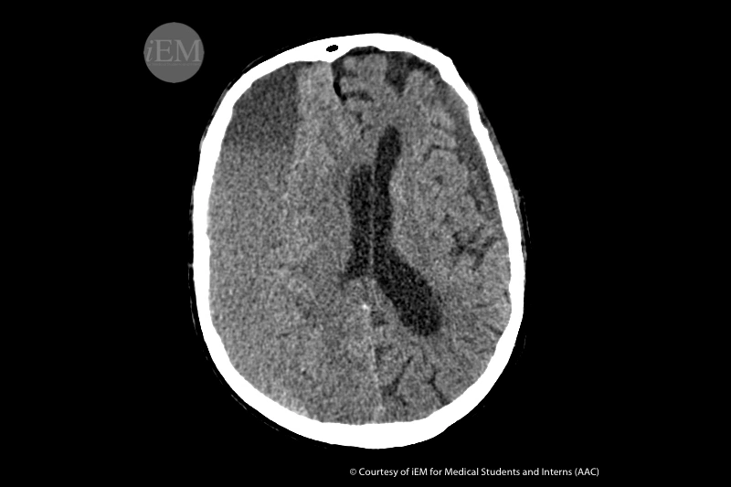 Activando el subdural