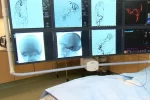 neurointervencionismo