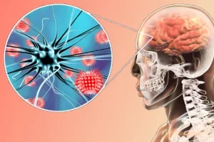 meningitis