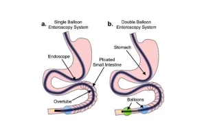 endoscopia_con_balones