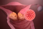 virus_papiloma_humano_VPH