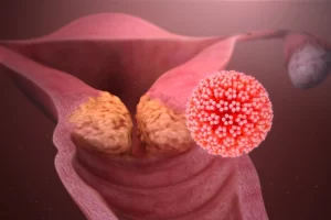 virus_papiloma_humano_VPH