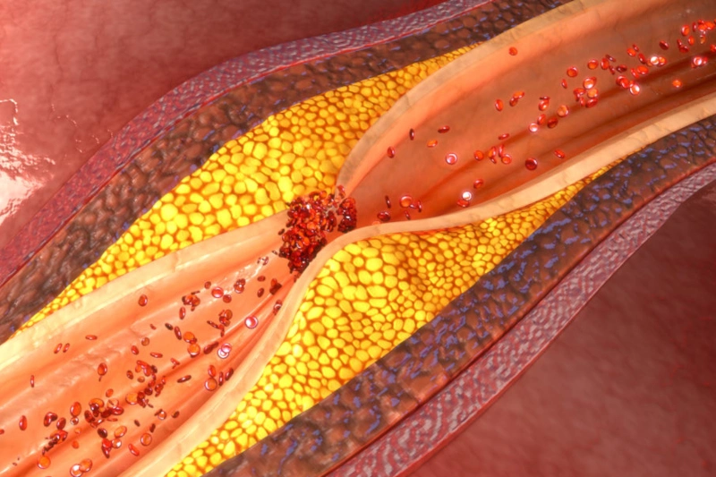 Aterosclerosis: la enfermedad que ha retado a científicos, a la tecnología y a la innovación