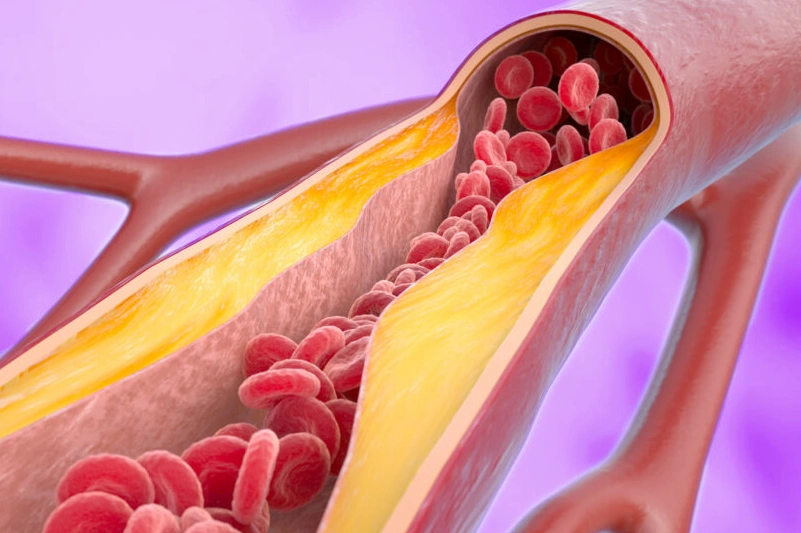 ¿Por qué es tan peligrosa la aterosclerosis?