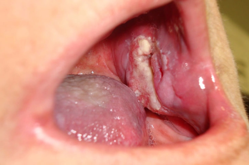 cancer-oral